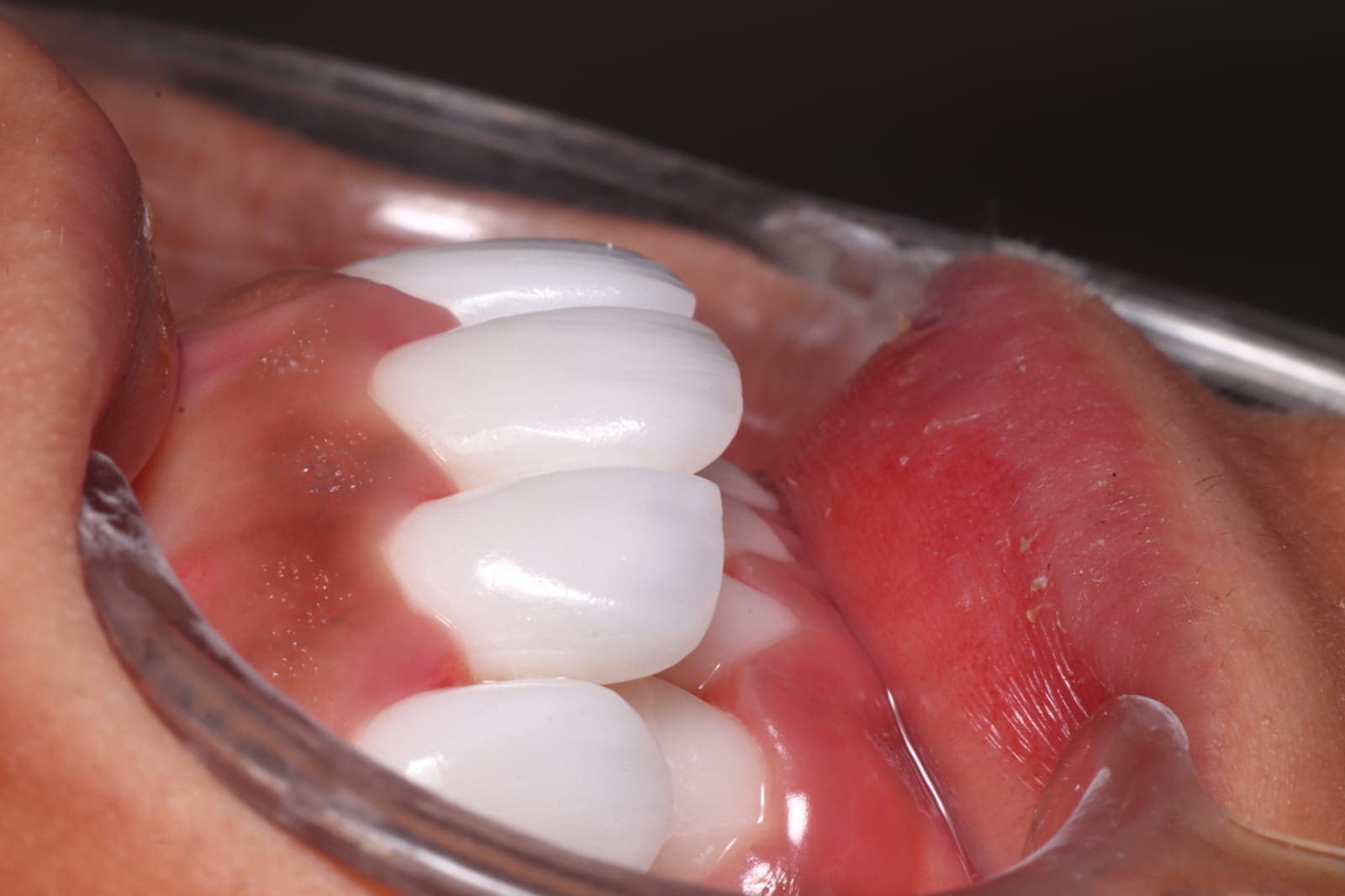 Before veneers treatment