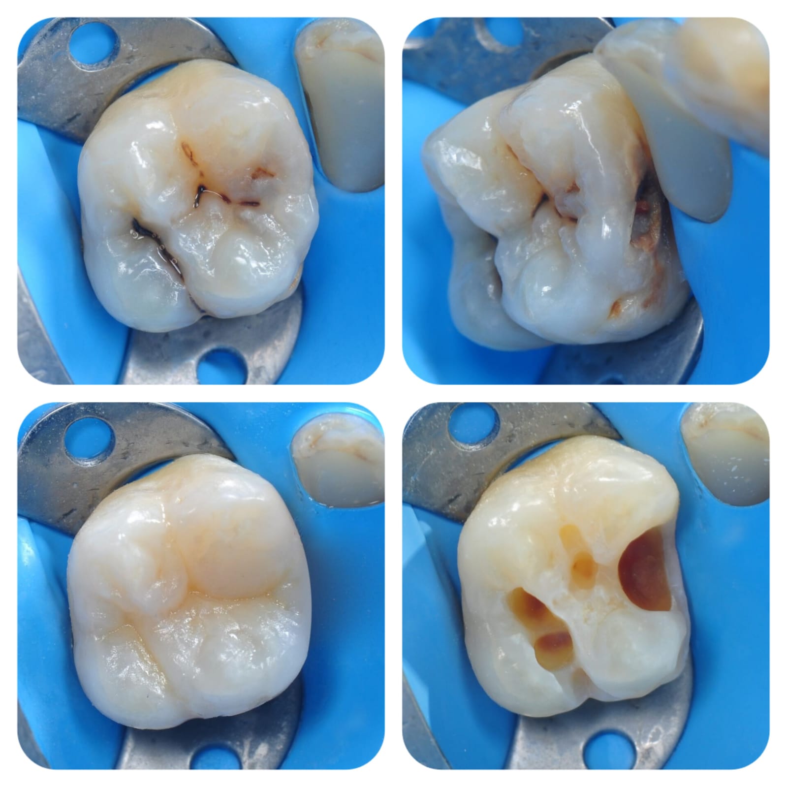 Before whitening