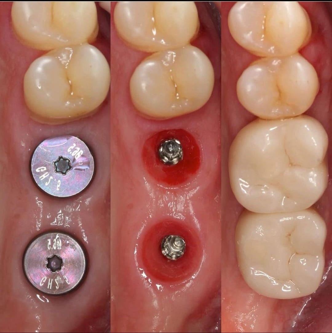 Before implant