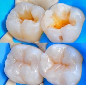 Aspen Dental Care Tooth Filling Bangalore