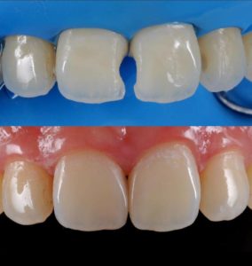 Aspen Dental Care Composite Tooth Filling Bangalore