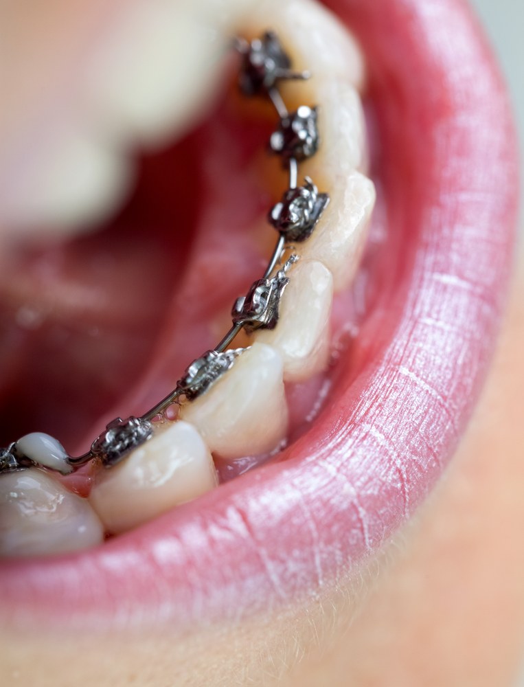 Aspen Dental Care Lingual Braces Bangalore