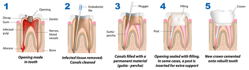 Aspen Dental Care Root Canal Treatment Bangalore