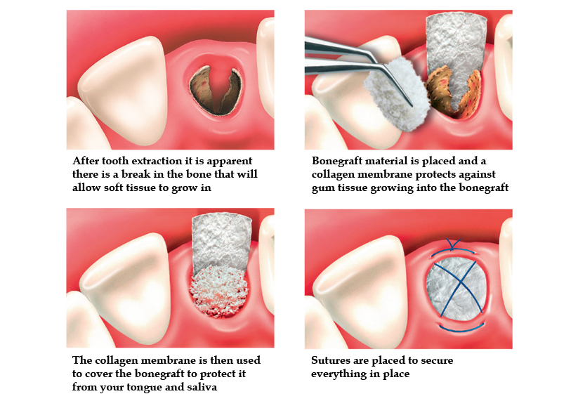 healing socket after tooth extraction