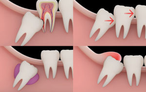 Aspen Dental Care Wisdom Tooth Extraction Bangalore