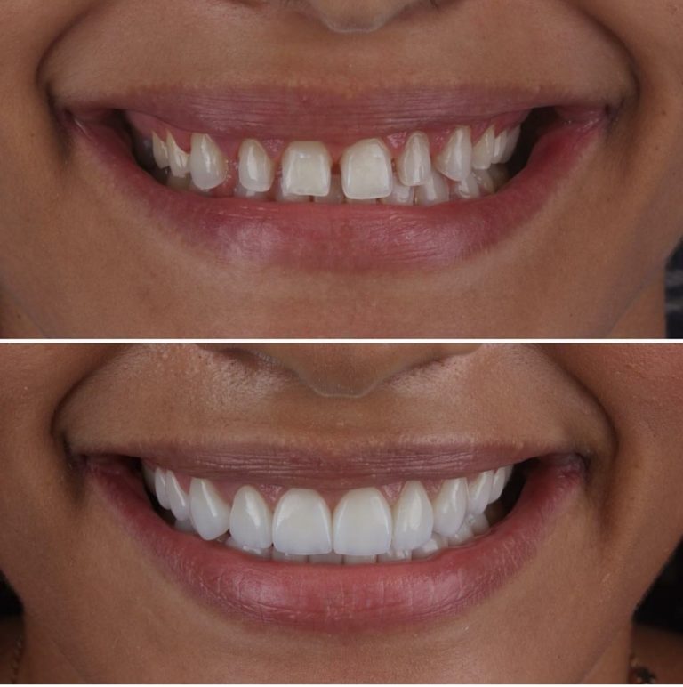 Aspen dental patient before after images