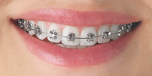 Aspen Dental Care Orthodontic Braces Bangalore