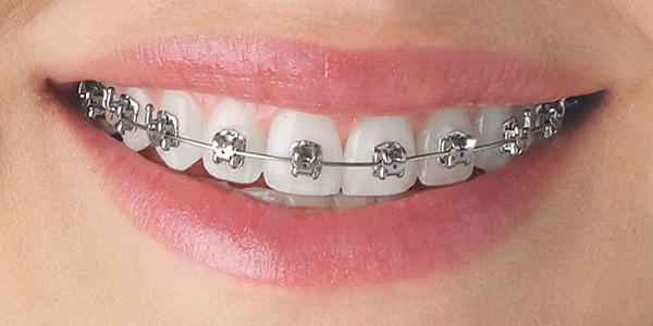 Braces — Align Dental Surgery