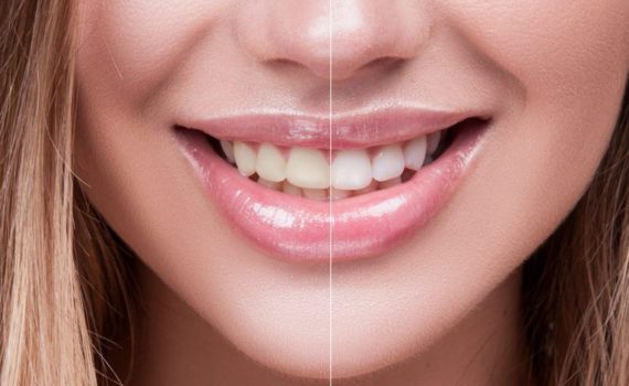 Aspen Dental Care Teeth Whitening Bangalore