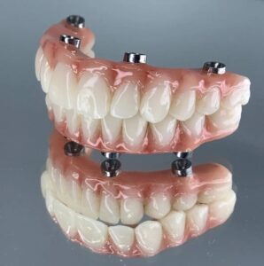 Dental Implants at Aspen Dental Care
