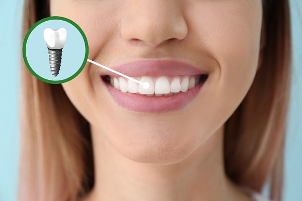 Dental Implants at Aspen Dental Care