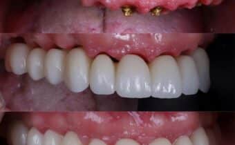 Dental Implants and Oral Health
