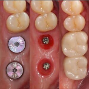 Role of Dental Implants in Oral Health