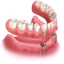 Aspen Dental Care Dental Implant Bangalore