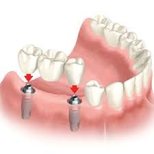 Aspen Dental Care Dental Implant Bangalore