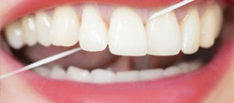 teeth cleaning aspen dental care