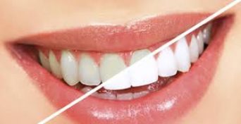 Aspen Dental Care Teeth Whitening Bangalore